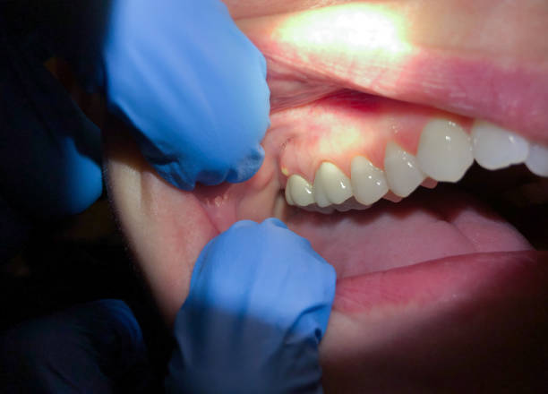 Best Emergency Dental Care for Abscessed Tooth in Lake Lorraine, FL