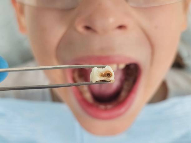 Best Emergency Dental Services for Seniors in Lake Lorraine, FL